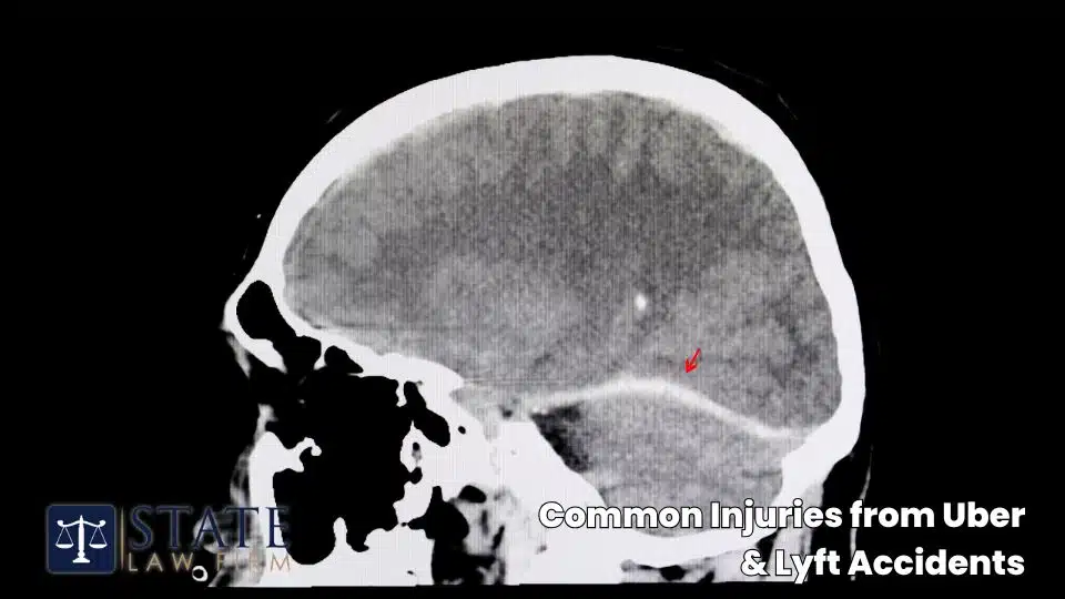 Uber & Lyft Accident Lawyers – Chico, CA 5 Common Injuries from Uber & Lyft Accidents